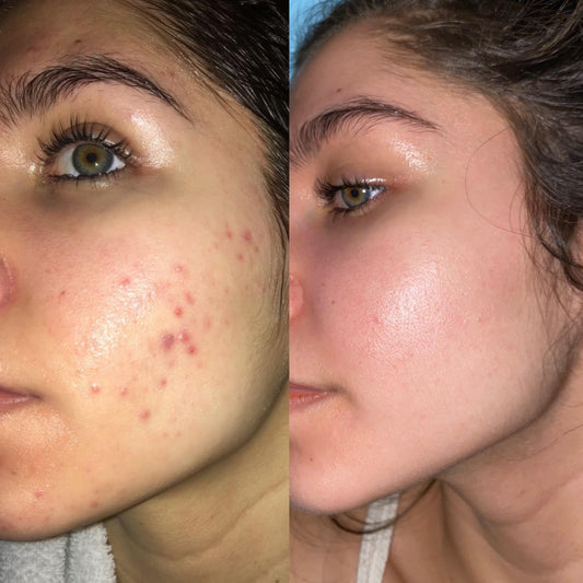 Adapalene Before and After: Transform Your Skin in 12 Weeks - QuickMedMD