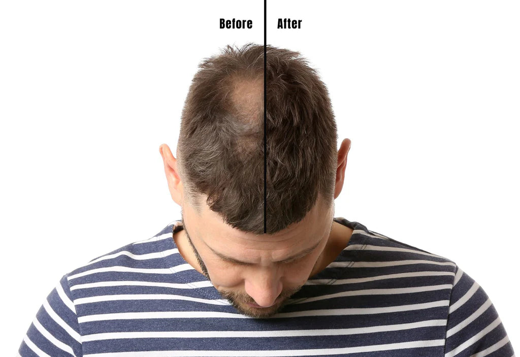 cheapest online finasteride prescription